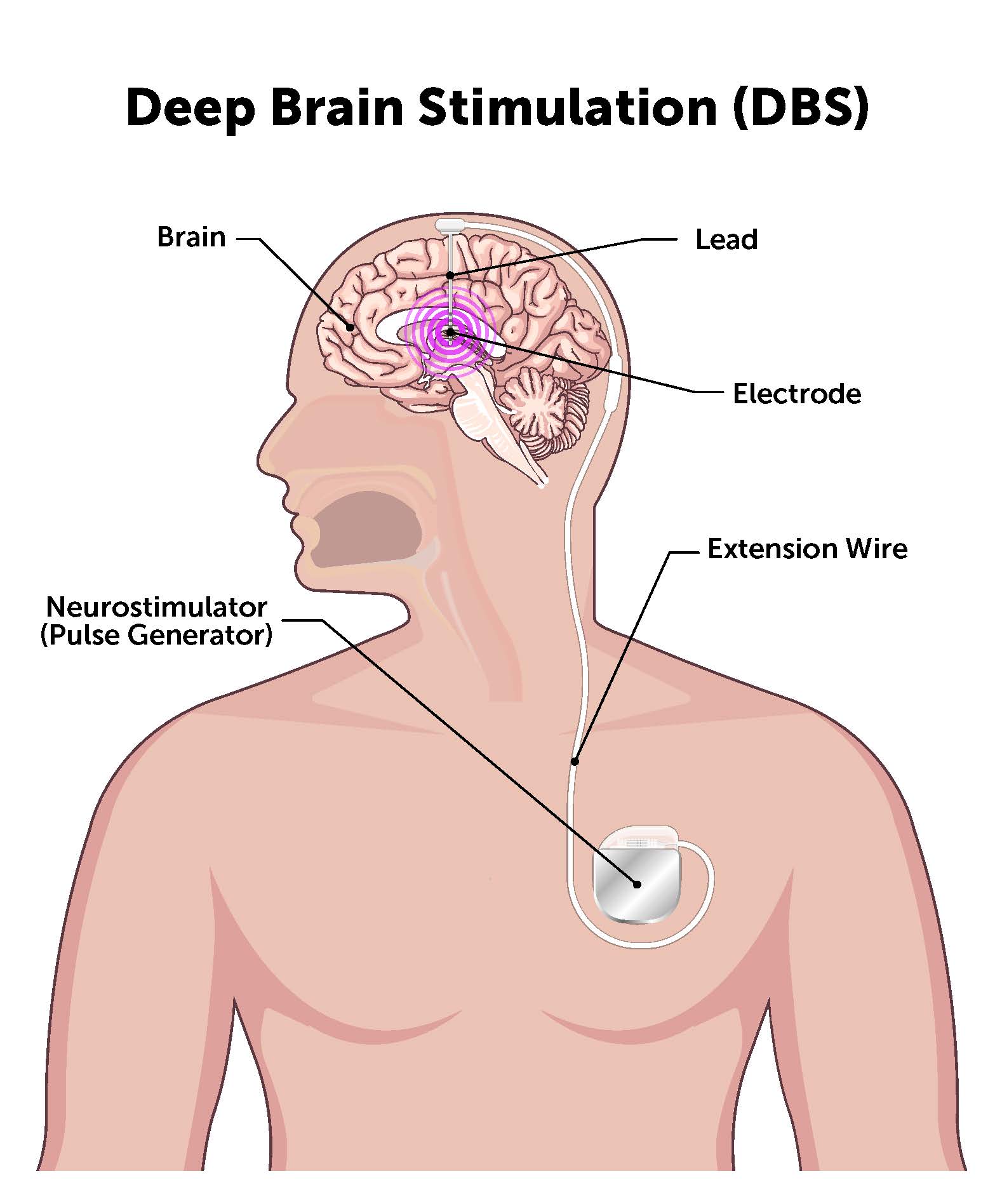 Deep brain